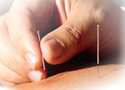 Acupunture thin filiform needle